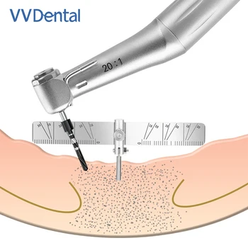 Набор локаторов для установки зубных имплантатов VV Для позиционирования полости рта Направляющая Стоматолога Линейка Инструмент